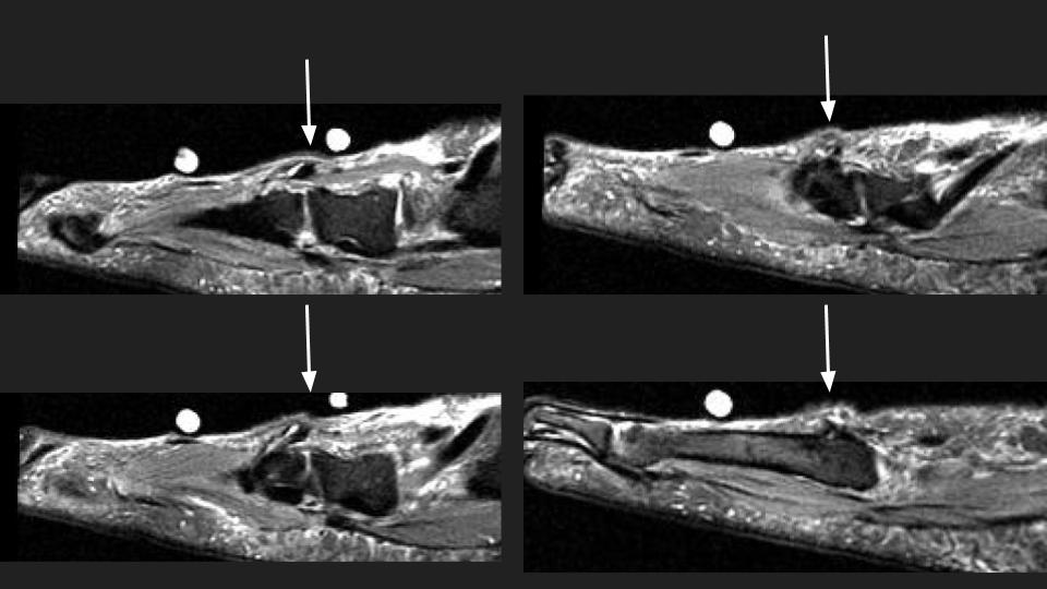 Figure 4 for case peroneus tertius ( RID2915 )